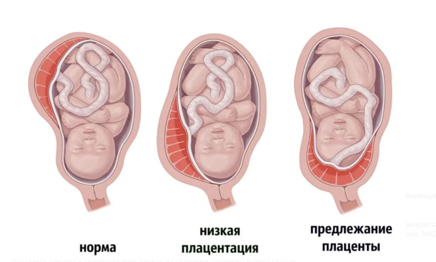 Кровотечения при беременности предлежание плаценты