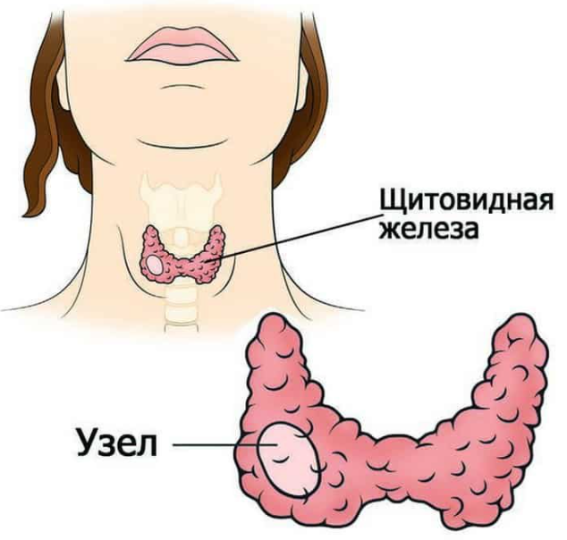 Узлы на щитовидке у женщин: причины, симптомы и лечение