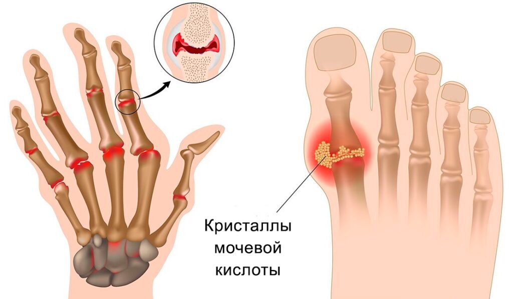 Вымой подагру из организма: напитки, которые помогают нейтрализовать мочевую кислоту