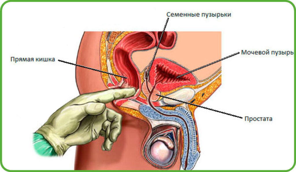 Массаж простаты: жизнь до и после