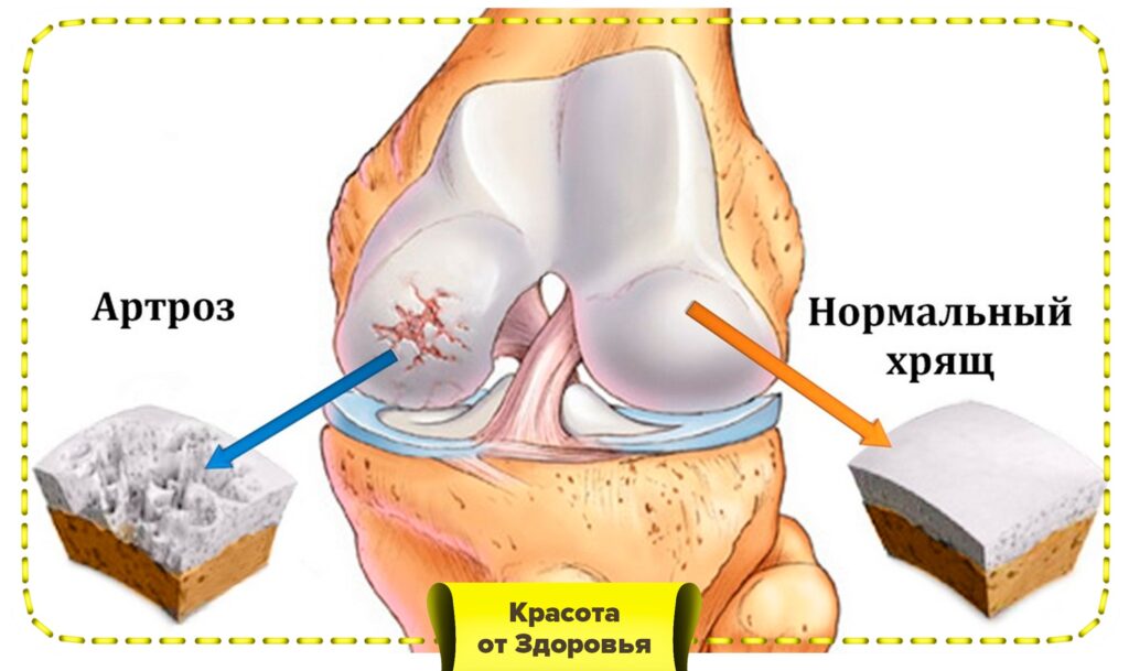 Факторы риска развития артроза и признаки заболевания