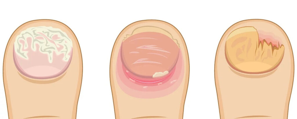 Грибок отсохнет с корнем! Возьми да намажь ноги обыкновенной…