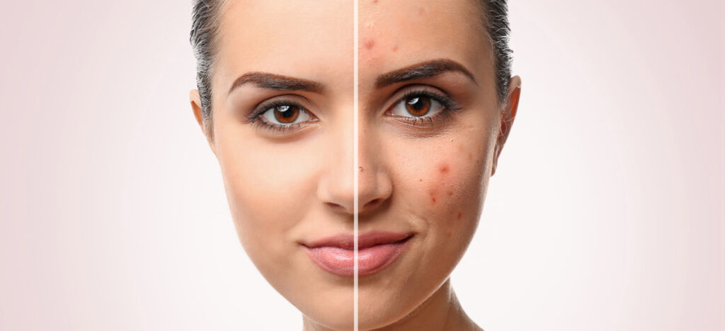 Не просто прыщ: как отличить фолликулит от акне (и справиться с ним)