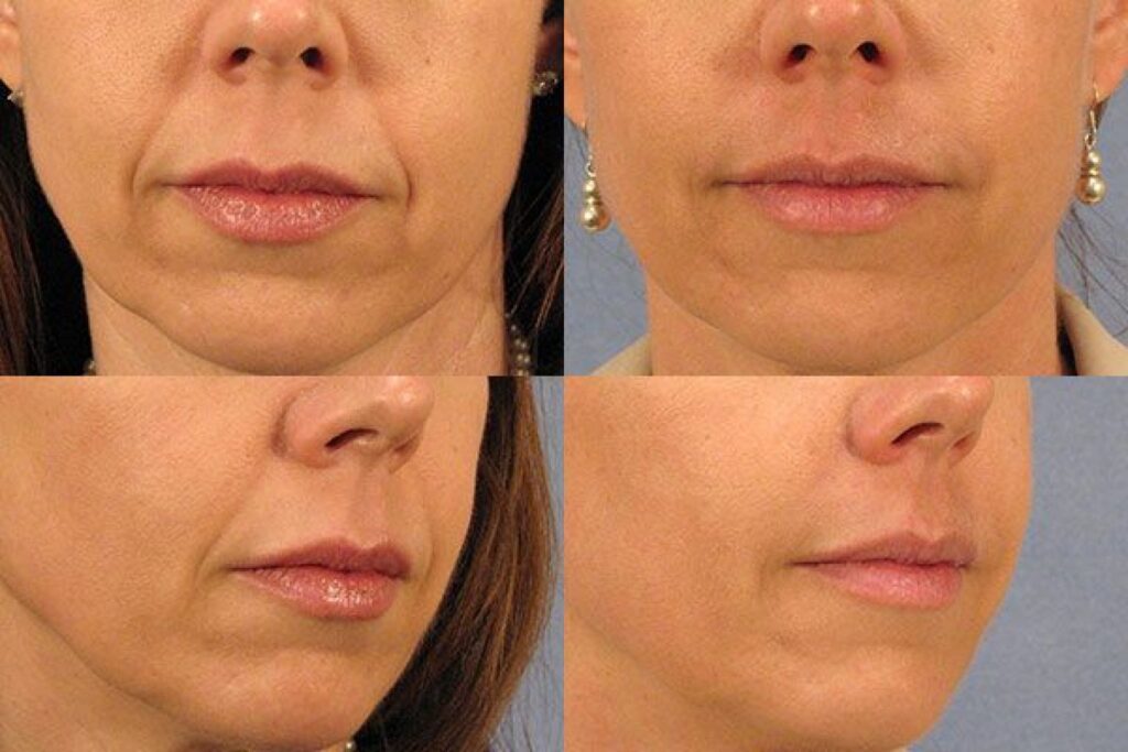 Расправляются носогубные складки и брыли: 3 точки &#8212; 3 минуты для массажа, даже лежа в постели делать можно