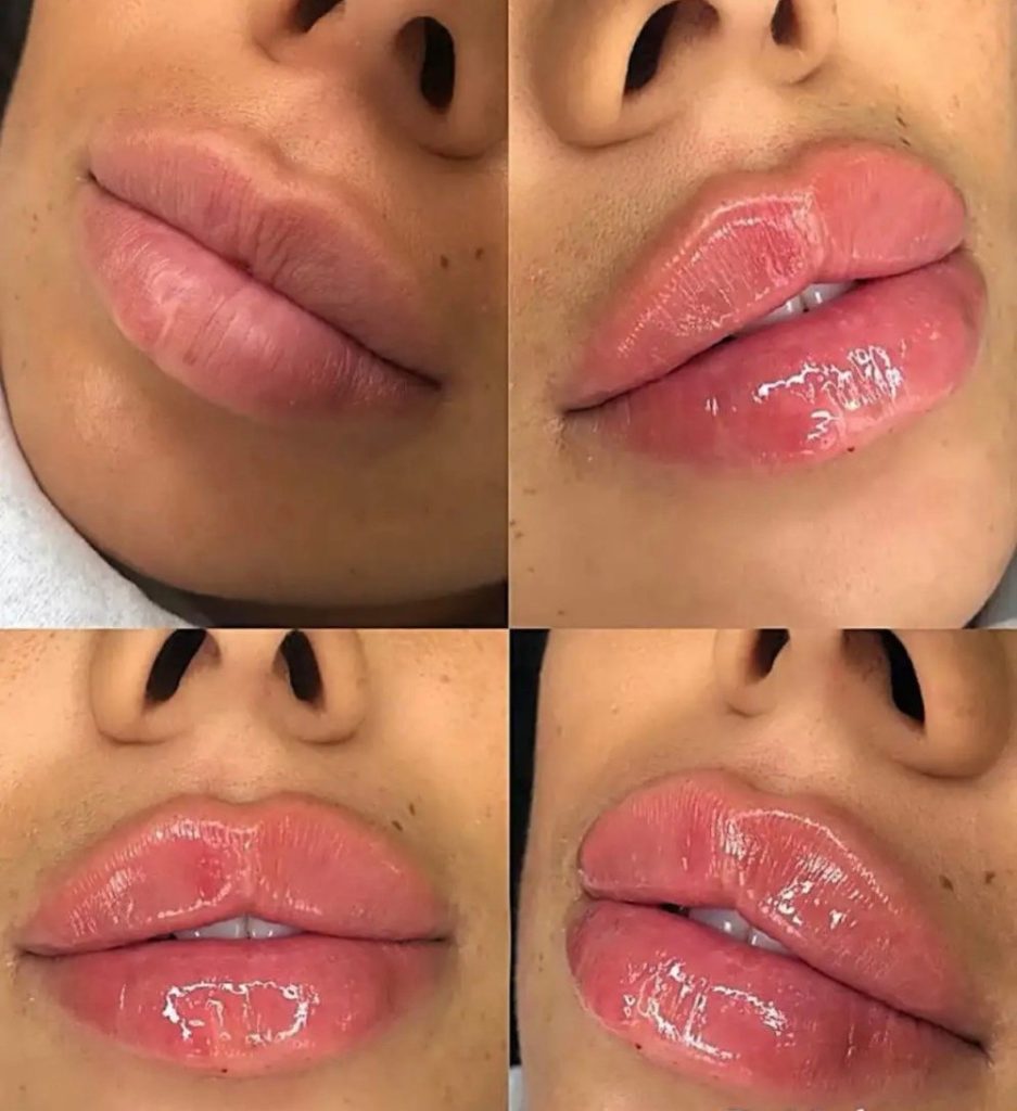 Сколько держится гиалуронка в губах — факторы, влияющие на результат