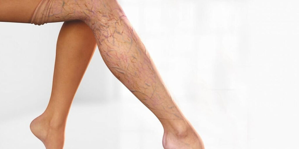 Лучшее лечение варикозного расширения вен в 2025 году