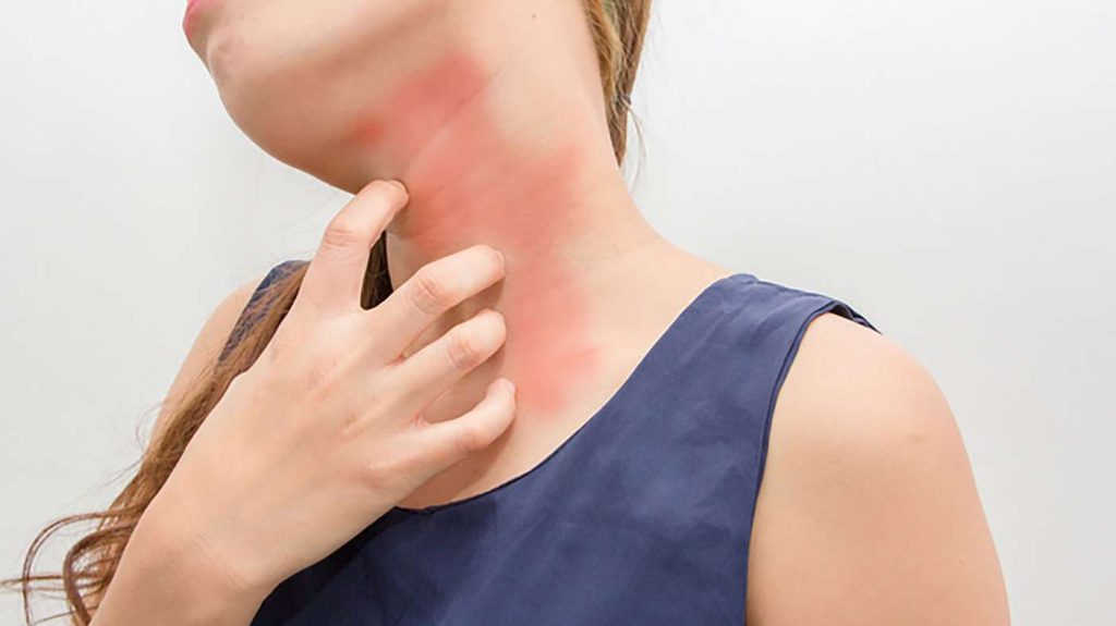 Аллергия на санскрин: как найти SPF, который не вызывает прыщи и раздражение