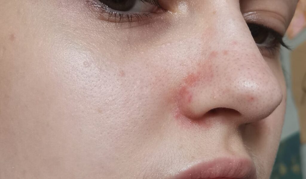 Шелушение кожи носа: причины и способы борьбы