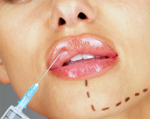 Правда ли, что филлер может сползти?