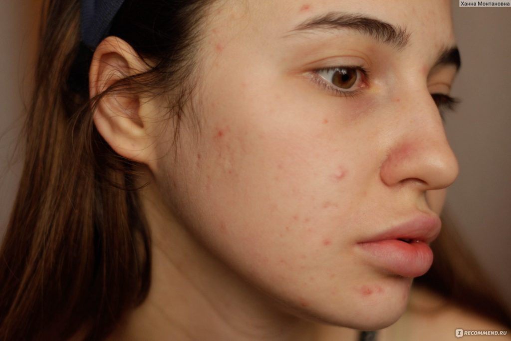 Прыщи от молока: правда ли, что молочные продукты могут быть причиной угревой болезни